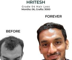 Redefine Your Look — Hairline Reconstruction Done to Perfection! - 2