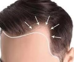 Stop Hair Loss Before It Stops You with Expert Treatment in Delhi! - 2