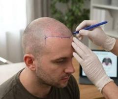 Activate Your Hair's Natural Power with PRP Treatment in Delhi!