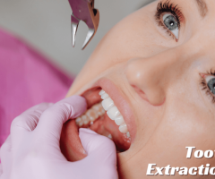 Get the Right Extraction Plan for Your Tooth