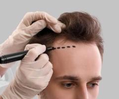 Hair Transplant in India — World-Class Results, Affordable Prices