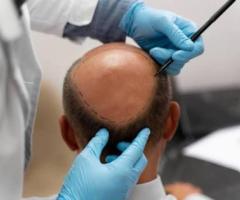 Get Premium Hair Restoration Without Breaking the Bank! - 2
