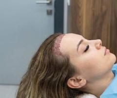 Choosing the Right Hair Transplant Surgeon in Germany