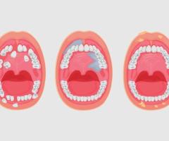 Best Oral Cancer Treatment Hospitals in Chennai