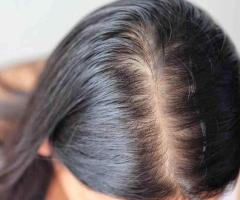 Best Hair Clinic in Noida – Trusted Natural Hair Loss Treatment