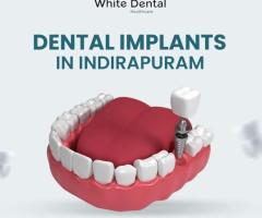 Trusted Dental Implants in Indirapuram for a Perfect Smile