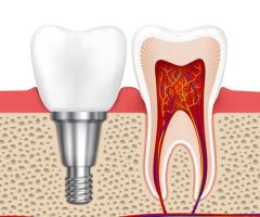 Dental Implants at White Dental Healthcare