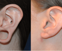 Book Expert Earlobe Repair Treatment in Delhi Now
