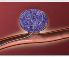 Coil Embolization Procedure for Minimally Invasive Vascular Treatment