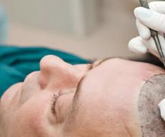 Celebrity Hair Transplant – Look Younger, Feel Better! - 2
