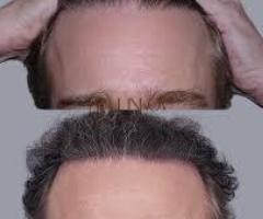 Experience the Future of Hair Restoration with Stem Cell Therapy - 2