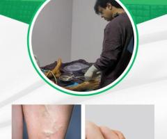 Varicose Veins Doctors - Best Specialist For Vein Treatment | IRFacilities