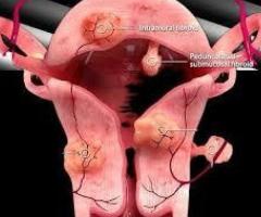 UFE Treatment for Uterine Fibroids | Minimally Invasive Care