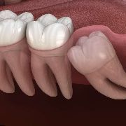 wisdom tooth removal singapore